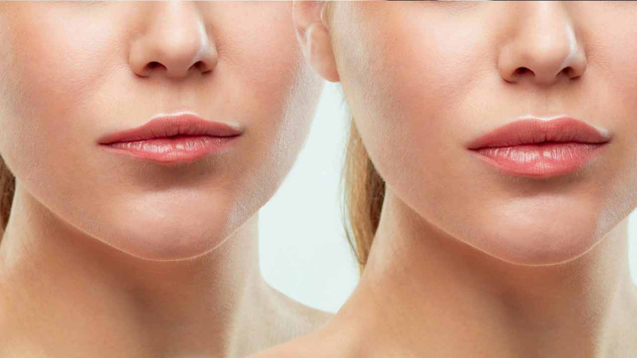 Dermal Fillers