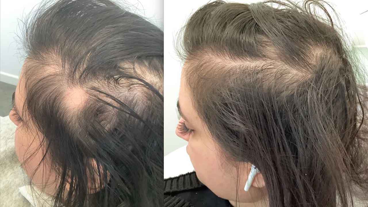 Alopecia (Patchy Hair Loss)