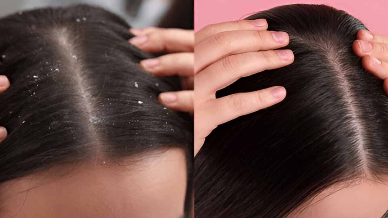 Dandruff & Scalp Flake Treatment
