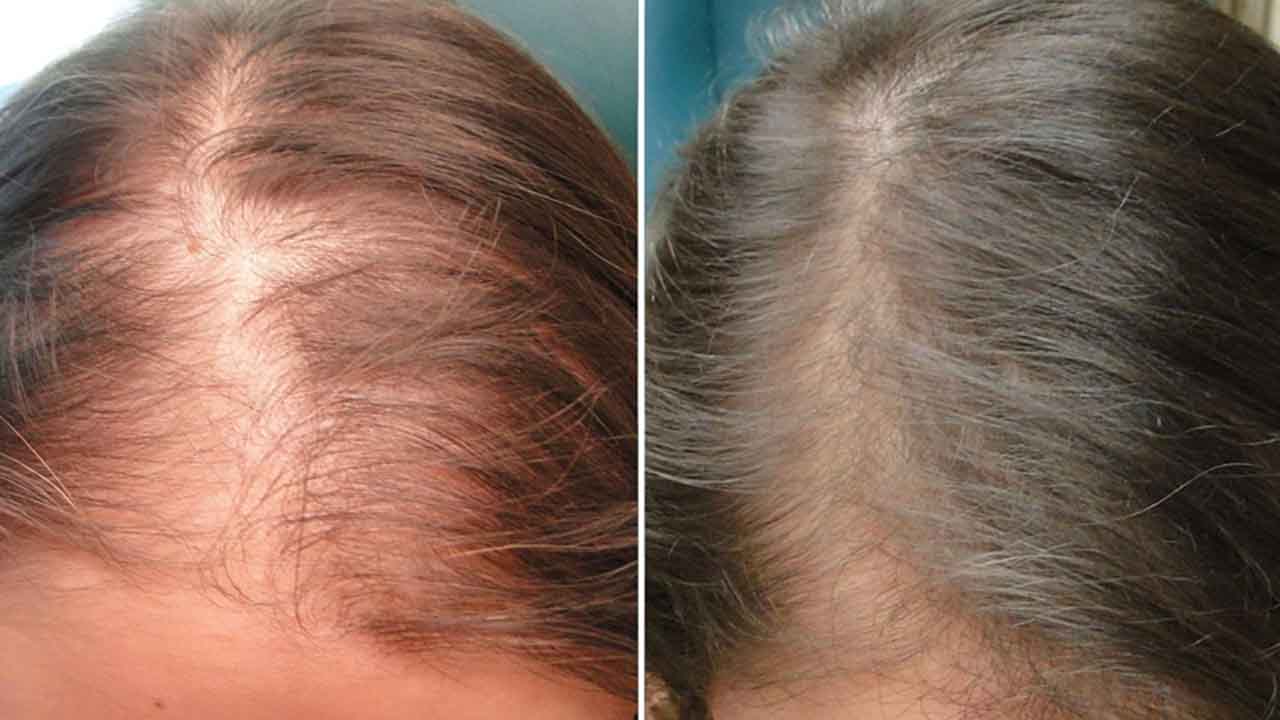 Mesotherapy for Hair Growth