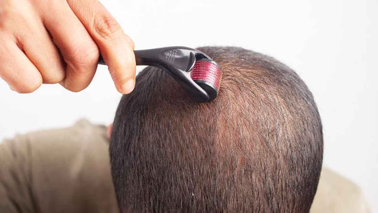 Microneedling for Hair Growth