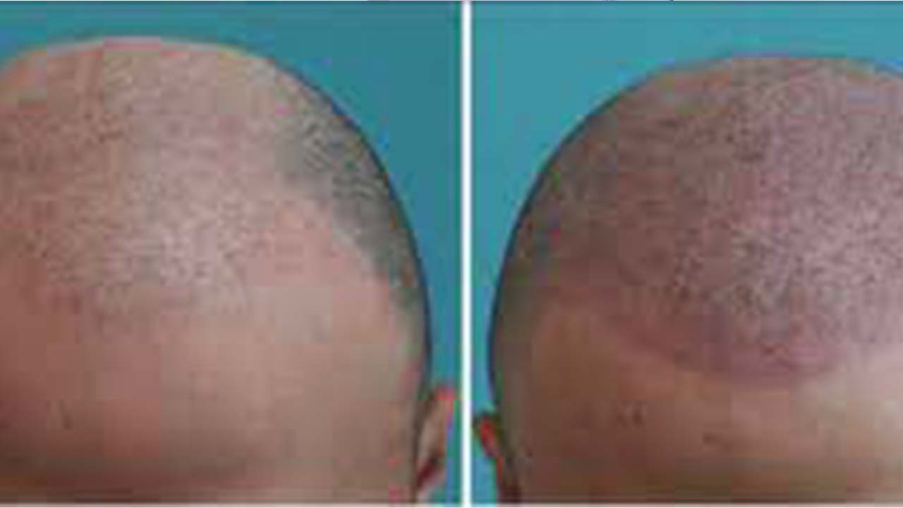 Scalp Micro Pigmentaion (SMP)