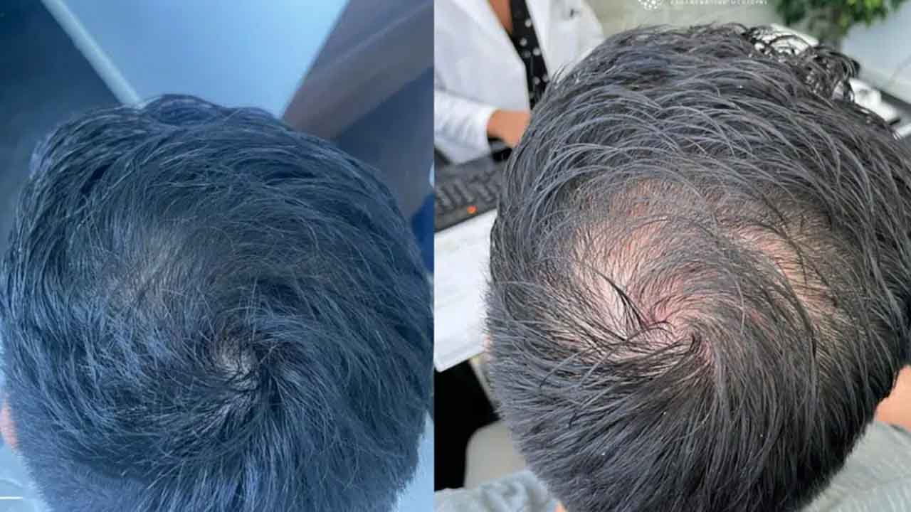 Stem Cell Therapy for Hair