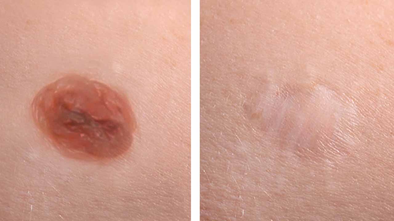 Mole Removal