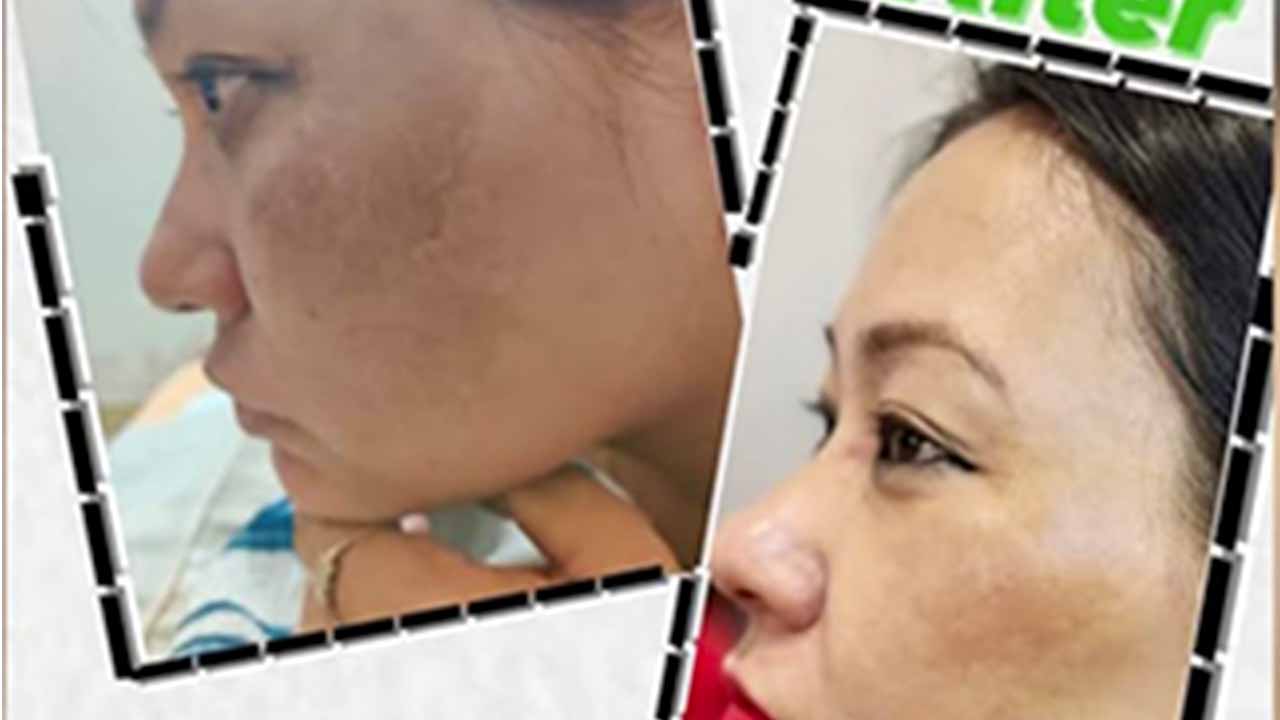 Pigmentaion Removal