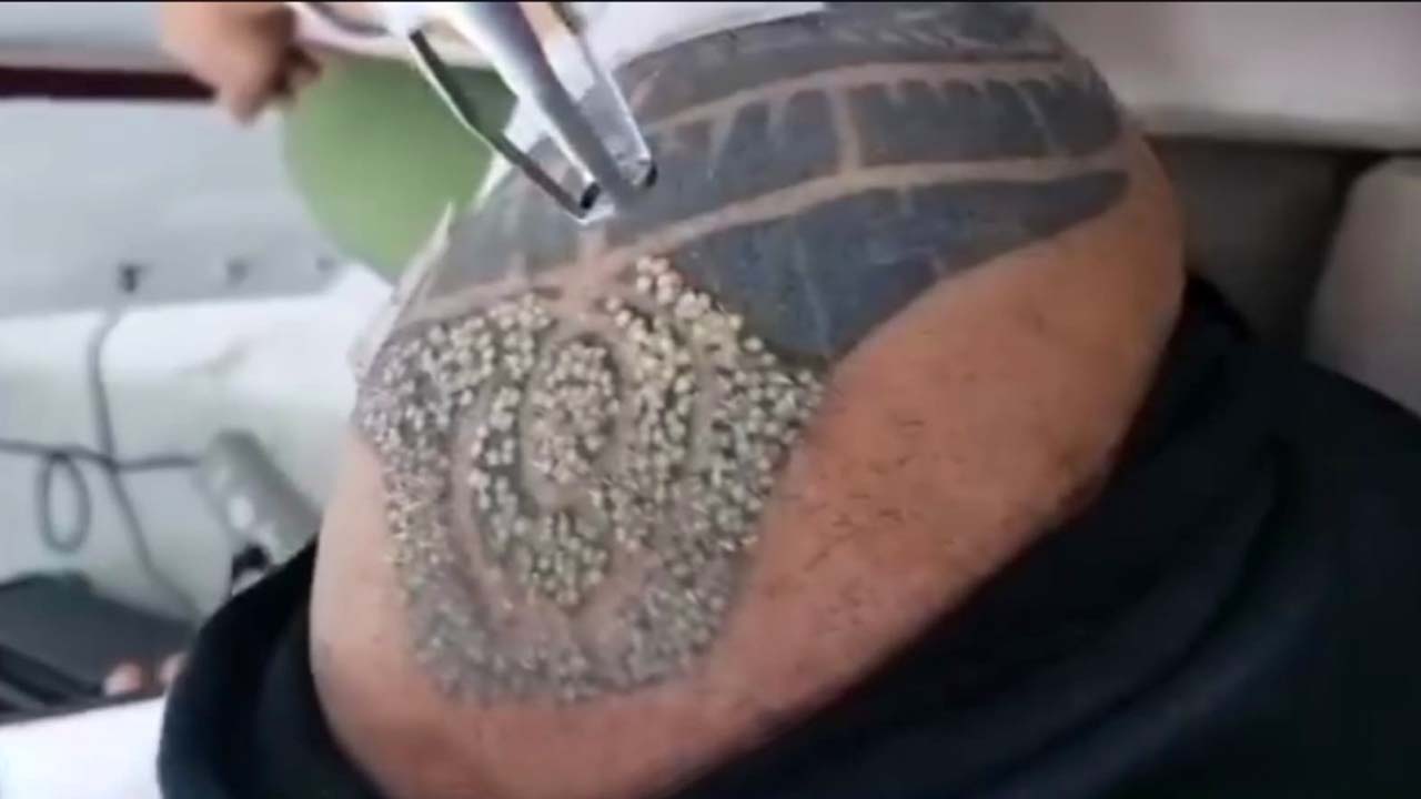 Tattoo Removal
